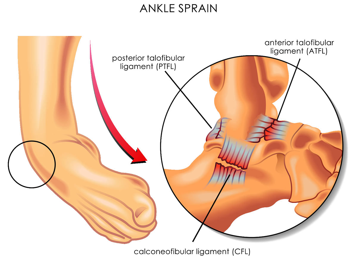Supination Trauma: Rolling your Ankle