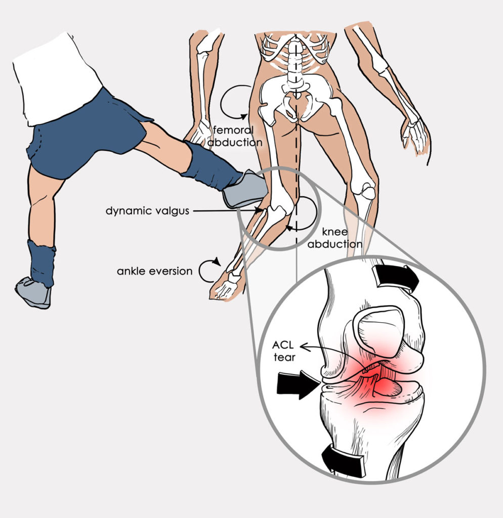 anterior-cruciate-ligament-acl-injuries-what-are-they-female