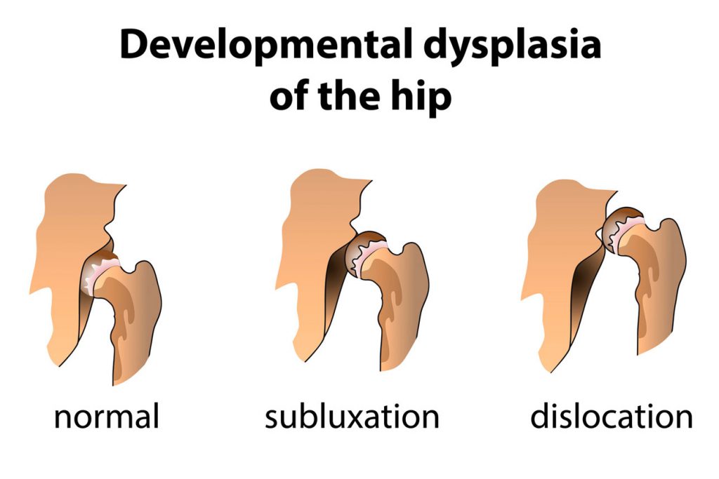 Developmental hip dysplasia